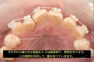 部分矯正による歯のガタガタ（叢生）治療で、隙間がないので、歯を少し削り（IPR）、隙間を作ります。